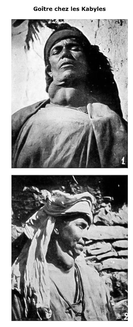 Goitre-Algerie-Bull-Path-exo-1912