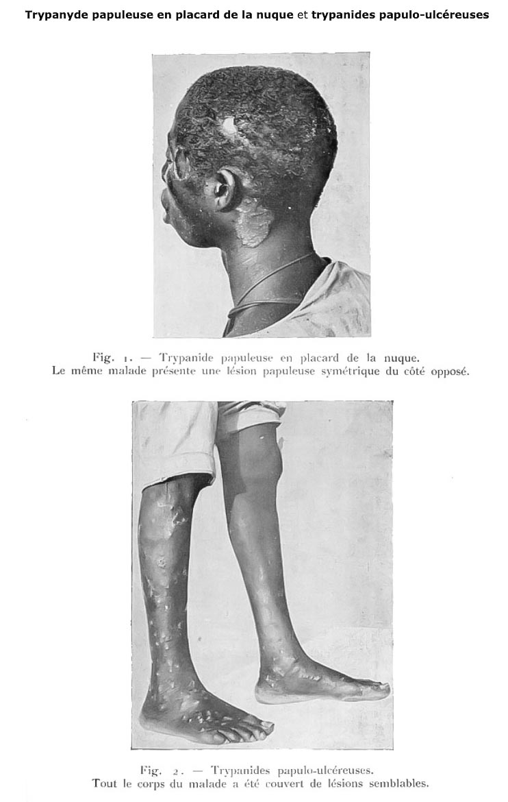 Trypanosomiase