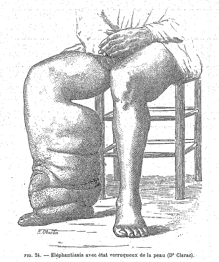 elephantiaisis filariose