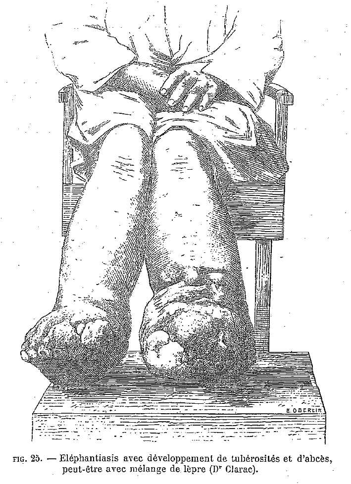 elephantiaisis filariose