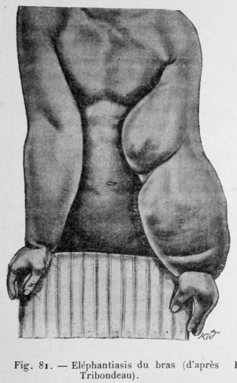 Filariose elephantiasis bras