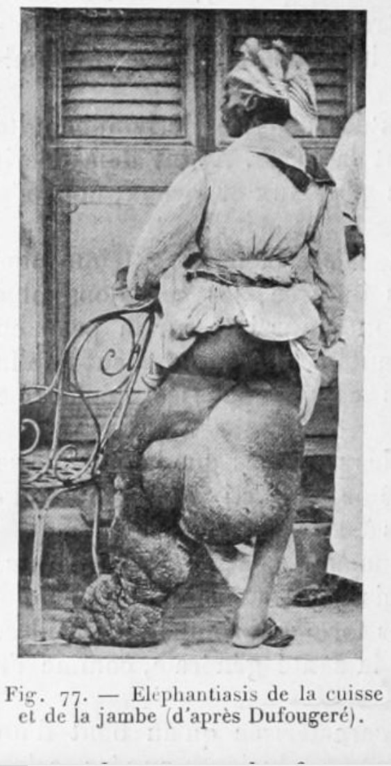 Filariose elephantiasis jambe cuisse