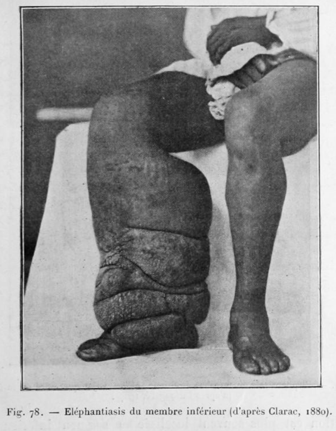 Filariose elephantiasis jambe cuisse