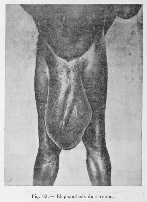 Filariose elephantiasis scotum