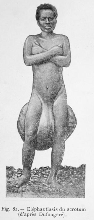 Filariose elephantiasis scotum