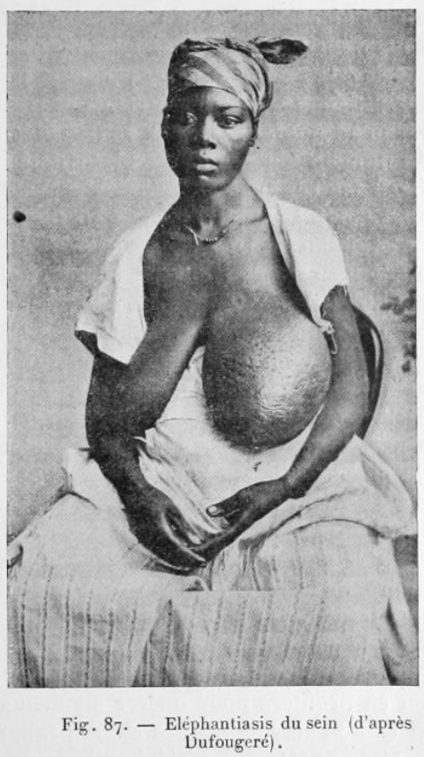 Filariose elephantiasis sein