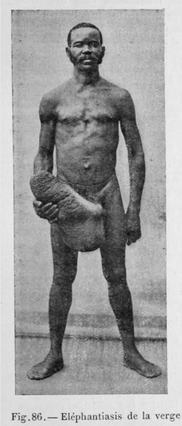 Filariose elephantiasis verge