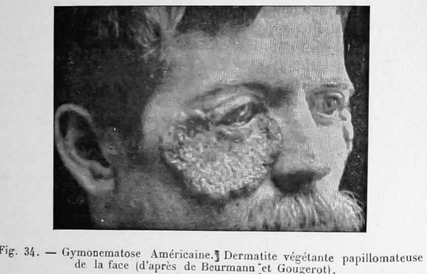 Gymonematose americaine dermatite vegetante dermatologie