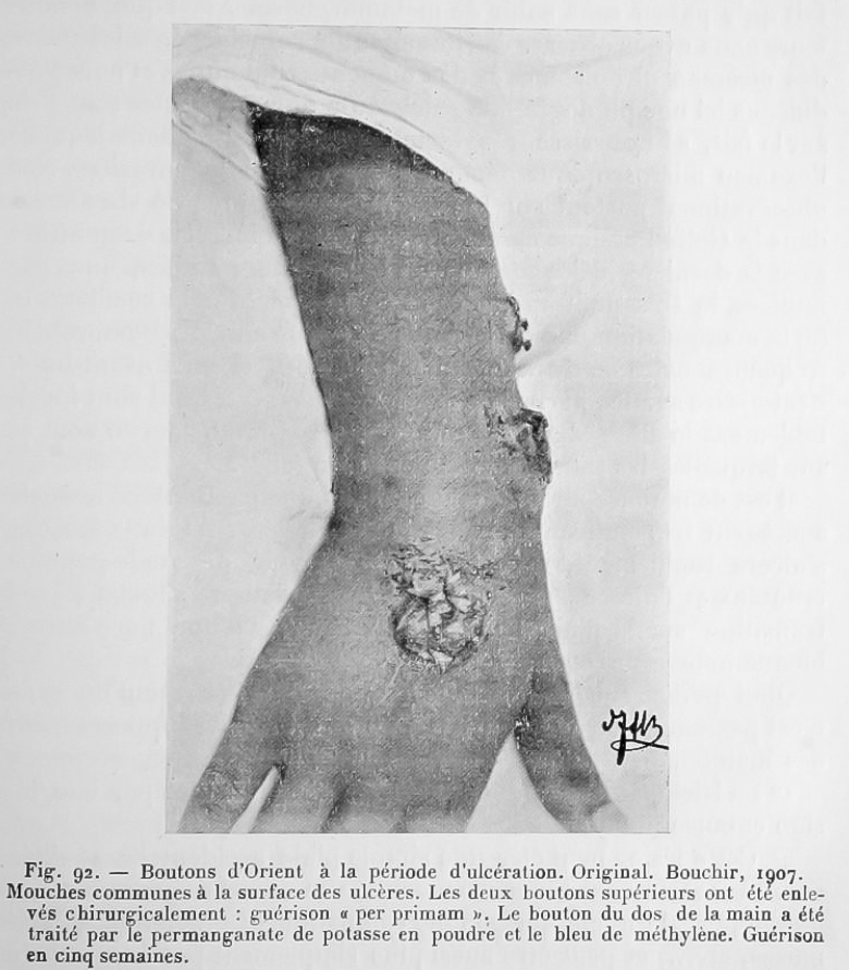 Leishmaniose cutanée dermatologie bras avant bras