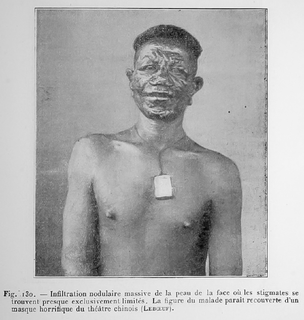 Lepre infiltration nodulaire visage