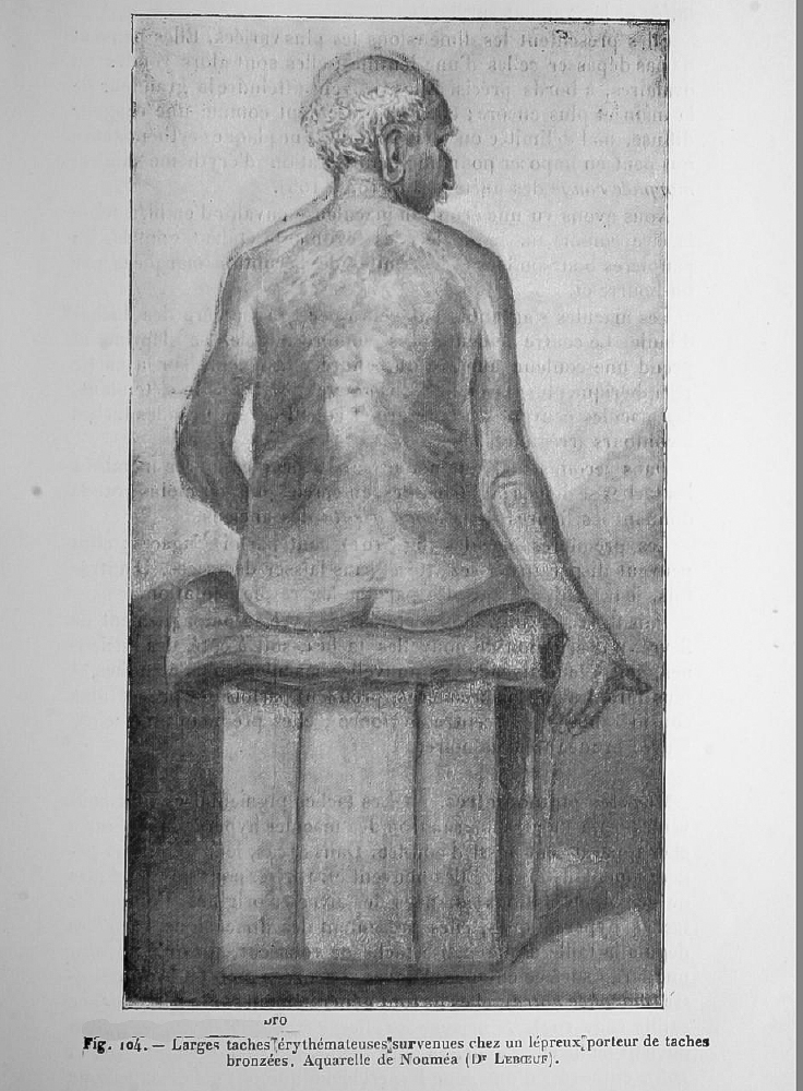 Lèpre Dermatologie