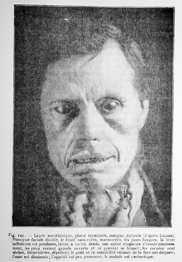 Lèpre anesthésique paralysie faciale masque antonin
